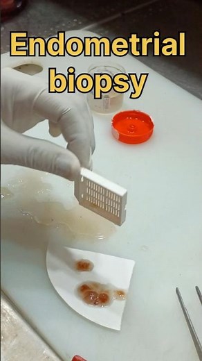 Endometrial tissue biopsy sample processing 😞😭😭| #histopathology #histomuseum #endometrium #biopsy