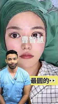 What Happens When Upper Blepharoplasty or Eyelid Surgery Goes Wrong?