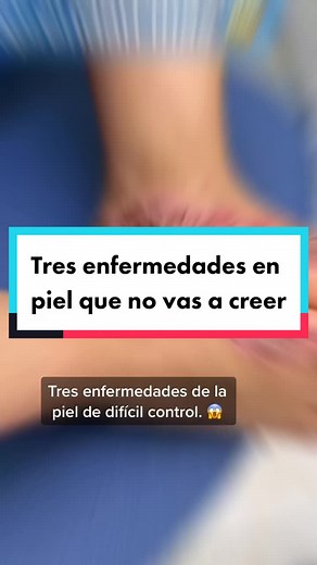 #CapCut tres casos increíbles 😱ha viste la segunda parte ? Te sorprenderás #tiktokcultura #dermatologomilitar #aprendeentiktok #psoriasis #dishidrosis #melasma