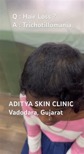 Hair loss due to hair-pulling? This could be Trichotillomania