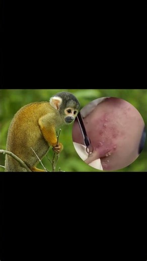 Removing Acne Blackheads on skin, cleaning everywhere