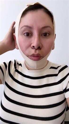 Day 3 After Facelift + Lip Lift Results So Far
