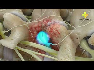 Selective Nerve Block Treatment | Dr. Kumars Healthcare