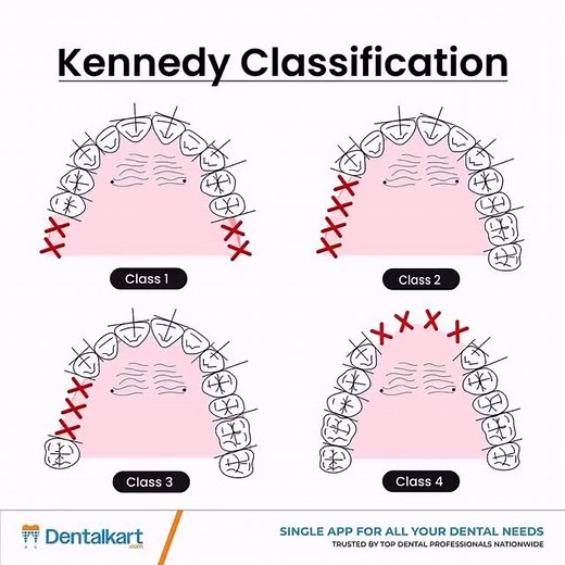 Dentistry My World 🌍 on Instagram: "𝐊𝐞𝐧𝐧𝐞𝐝𝐲’𝐬 𝐂𝐥𝐚𝐬𝐬𝐢𝐟𝐢𝐜𝐚𝐭𝐢𝐨𝐧 𝐌𝐚𝐝𝐞 𝐒𝐢𝐦𝐩𝐥𝐞! When it comes to designing removable partial dentures (RPDs), understanding Kennedy’s Classification is key! It helps clinicians identify the pattern of missing teeth and plan the most suitable prosthesis design. Here’s a quick overview: 🔹 Class I: Bilateral edentulous areas located posterior to the remaining natural teeth. 🔹 Class II: A unilateral edentulous area located posterior to the
