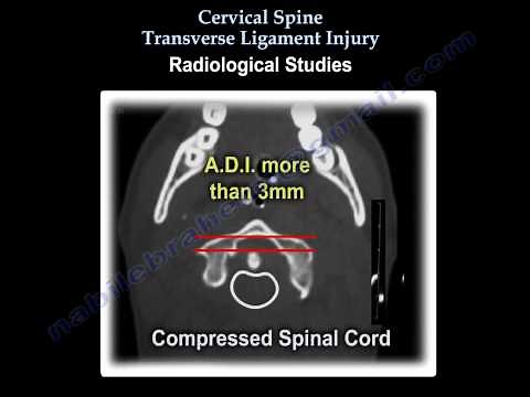 Cervical Spine injury, Transverse Ligament Injury - Everything You Need To Know - Dr. Nabil Ebraheim