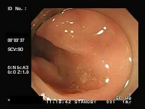 大腸内視鏡検査 TypeC No2 Colonoscopy