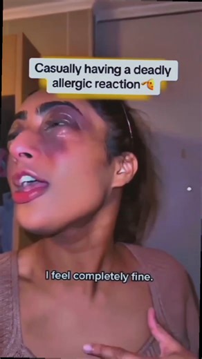 An allergic reaction that requires immediate medical attention often involves symptoms like difficulty breathing, chest tightness, swelling of the face, lips, or throat (angioedema), and a rapid or irregular heartbeat. Additionally, severe hives, intense itching, dizziness, or a sudden drop in blood pressure (which may cause fainting) are signs of a life-threatening reaction called anaphylaxis. If someone experiences these symptoms, they should seek emergency care right away. #allergicreaction #