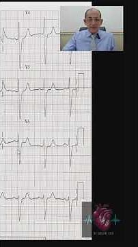 Right bundle branch block ECG (6)