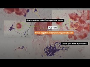 Gram positive and negative bacteria in Sputum Gram staining