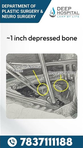 Fractures of forehead #drashishgupta #plasticsurgeon #ludhiana