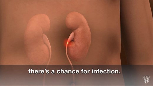 12K views · 205 reactions | Mayo Clinic News Network produced more than 200 health and medical videos in 2019. What medical stories resonated with viewers the most? This week, we look at the top viewed Mayo Clinic Minutes of 2019. The story that came in at No. 2 on the list is "Avoiding kidney stones." https://mayocl.in/2Q1BqjH | Mayo Clinic | Facebook