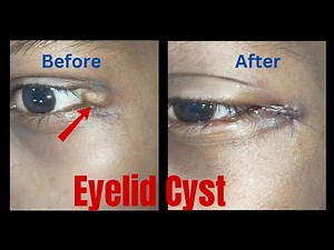 Cyst removal surgery| eyelid cyst removal| eyelid surgery in Ranchi| how to remove eyelid cyst