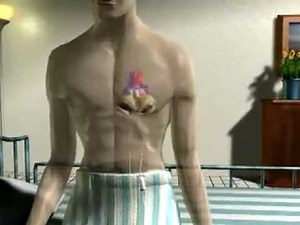 Syncardia Total Artificial Heart (TAH) | MyLVAD