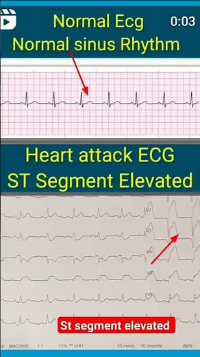 NORMAL Vs ABNORMAL ECG🫀