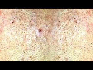 Nodules Removal Blackheads On The Face Easy | How To Remove Blackheads Easy
