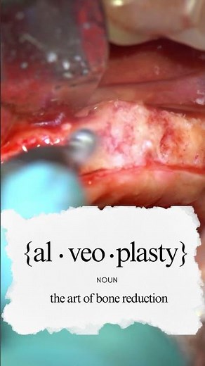 The art of bone reduction #alveoplasty #dentalimplants #dentistry #oralsurgery
