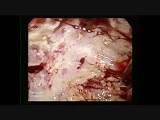 Laparoscopic Excision of Hydatid Cyst of Liver • Video • MEDtube.net