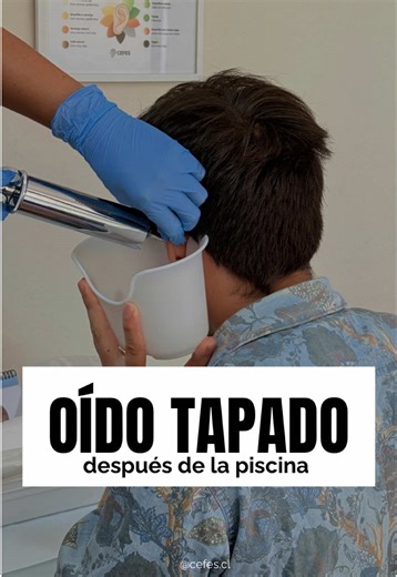 💦👂 ¿Saliste de la piscina y sientes el oído tapado? Después de nadar, el agua puede quedar retenida en el conducto auditivo. Si tienes tapón de cerumen, este se hidrata, se expande y genera esa sensación incómoda de presión, eco o disminución de audición. Muchas veces no duele… pero sí molesta 😣 Y los cotonitos solo empujan más el cerumen hacia adentro ⚠️ ✨ La solución no es adivinar, es evaluar. En nuestro centro realizamos evaluación previa con video otoscopía para confirmar si hay tapón de