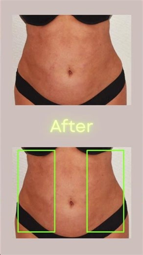 Botched Liposuction Fix: Shocking Revision Transformation! 😱✨