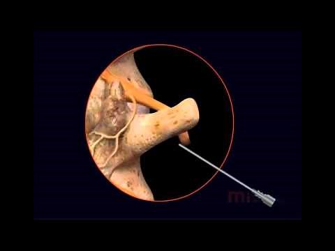 Lumbar radiofrequency ablation