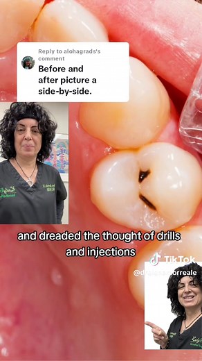 Heal cavities with bentonite clay! Before and after results using Fortbite. Biological dentistry for the win! 🦷🪥 @dr.holistic #calciumbentoniteclay #remineralizingtoothpowder #remineralizeyourteeth #biologicaldentist #toothpowder #bentoniteclay #teethcare