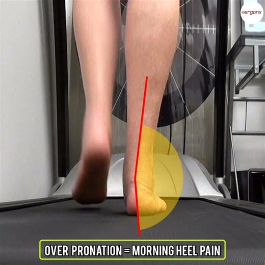Beat Morning Heel Pain: Solutions for Over-Pronation #HeelPain #OverPronation #FootHealth