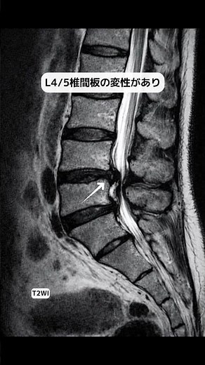 椎間板ヘルニア #radiology#MRI#ショート#shorts
