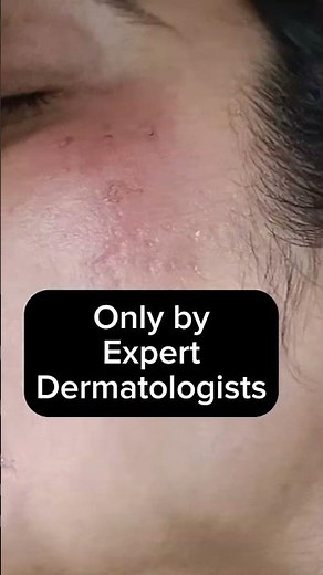 Freckles Treatment l Plasma Pen l Expert Dermatologist