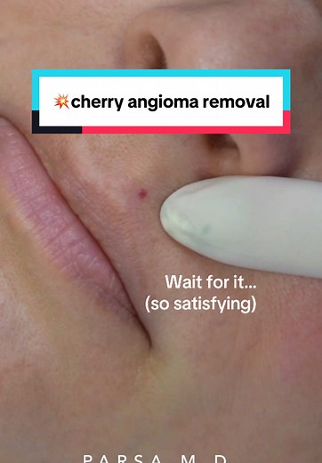 Cherry Angioma Removal with Laser Treatment Explained