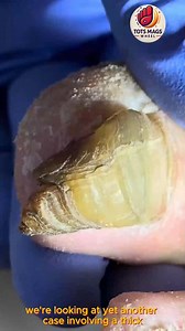 Essential Guide to Help Individuals with Circulation Issues Clean Toenails Safely #SafeNailCare #FootSupport #EverydayCare | Tots Mags Wheel