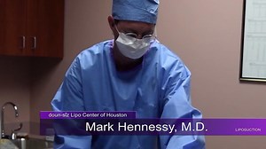 Liposuction: Sculpt and Contour Your Body to Get Rid of Stubborn Fat