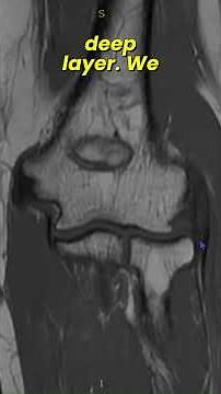 TENNIS ELBOW ! #MSK #Radiology #MRI #Case #|FOAM#Teach#Review#athlete#trauma#construction #anatomy