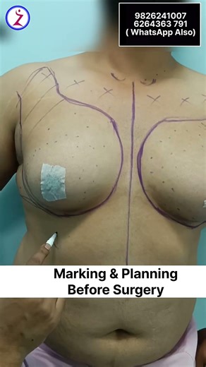 Best Gynecomastia Doctors Near Me in Bhopal? Him.