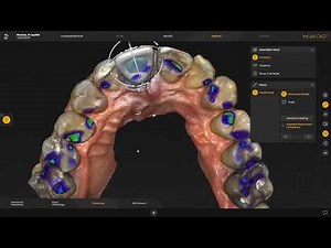 Front kroon design in inLab 22 software