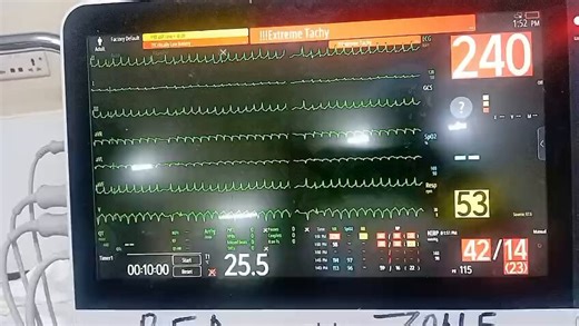 🫀✨️An interesting case from my friend @EdwardTutu8 🗣Narrow-complex tachycardia (SVT) – Unstable? Immediate synchronized cardioversion is the priority.➡️Unstable = hypotension, signs of shock, altered mental status (confusion), or ischemic chest pain.📚Why? Extreme rates (>150 bpm) slash diastolic filling time ➡️ plummeting cardiac output, cerebral hypoperfusion, and myocardial oxygen supply-demand mismatch (ST depression is expected, not surprising).➡️Per AHA ACLS (2025 algorithm):Synchronized