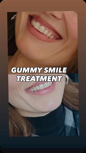 Op.Dr. Seda Asfuroğlu on Instagram: "|| Gummy Smile Treatment with Botox ||✨ Botox is a non-surgical and minimally invasive solution for a gummy smile 😊 It relaxes the upper lip muscles that lift the lip too much while smiling 👄⬆️ As a result, less gum is visible and the smile looks more balanced and natural 😁✨ ⏱️ Quick procedure 😌 Virtually painless 🚫 No downtime 📆 Results last 3–6 months Every surgical and interventional procedure carries risks. Results may vary from person to person. Th