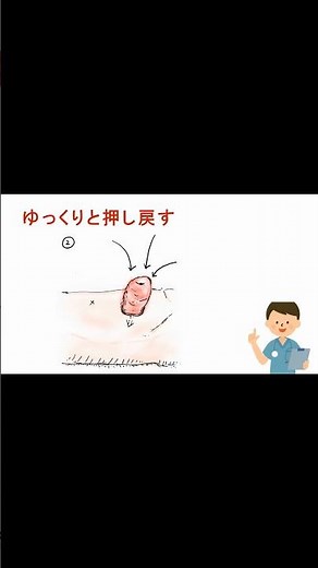 【ストーマ脱】これ大丈夫？原因と対策を1分で解説！#Shorts 007