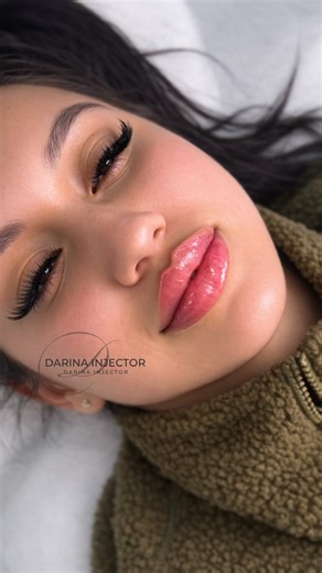 Lips, Botox, Fillers New York/Miami on Instagram: "Our signature Russian Lips technique is designed to enhance your natural beauty — not overpower it. This method focuses on precise structure, elegant lift, and perfectly balanced volume for a fresh, refined look. ✨ Sharp cupid’s bow ✨ Defined lip contour ✨ Soft, natural projection ✨ No heavy or overfilled appearance Every treatment is fully customized to your facial anatomy to create lips that look luxurious, harmonious, and effortless — from ev
