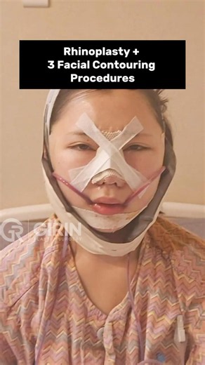 The Ultimate Korean Face Transformation: Rhinoplasty + Facial Contouring