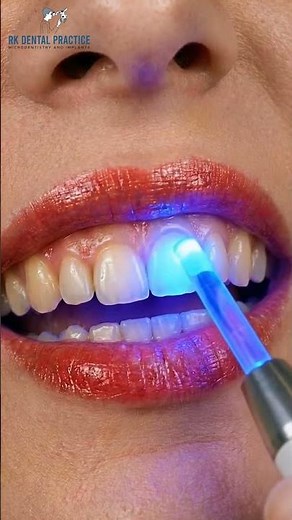 How We Fix Cavity in 5 Minutes | Dental Filling Procedure | RK Dental Practice