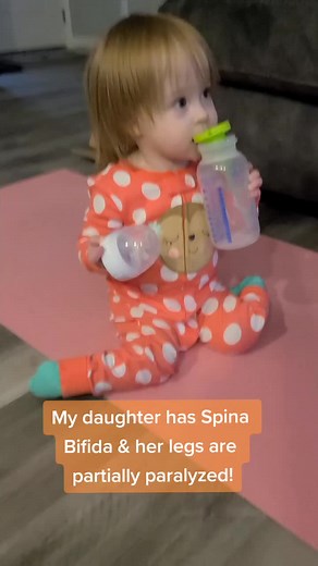 #spinabifidaparent #tibialtorsion