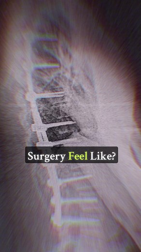 Understanding Spinal Fusion Surgery Recovery Process