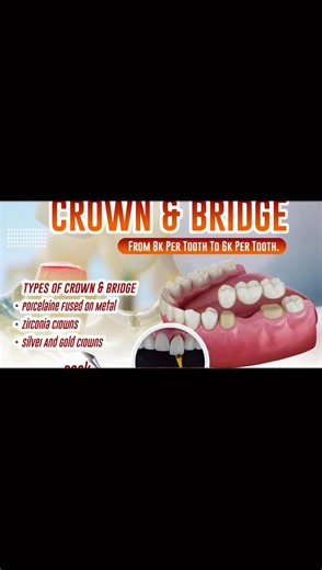 💫A Porcelain-Fused-to-Metal (PFM) crown is a dental restoration that combines the strength of a metal substructure with the natural, tooth-colored appearance of porcelain. It is a reliable, time-tested option widely used to protect and restore damaged or heavily decayed teeth. ✨How PFM Crowns Are Made ✅PFM crowns feature a two-layer design: 🦷Metal Substructure: The inner core is made from a strong metal alloy (such as gold, nickel, or chromium). This gives the crown its durability, structural 