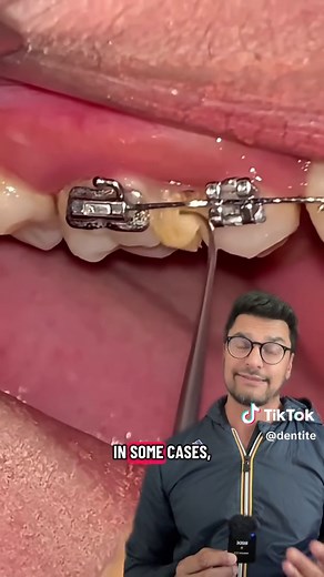 How to Floss Properly: Step-by-Step Guide