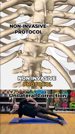 How to Fix Scoliosis Without Surgery