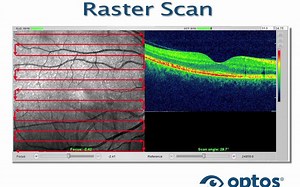 教学视频：带视野检测功能的Optos光学相干断层扫描与激光扫描检眼镜（Optos OCT SLO with MicroPerimetey）4.