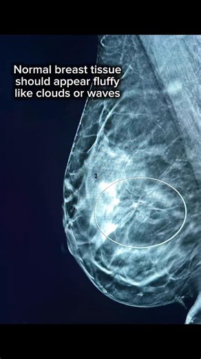 Mansi Vaishnav, MD, DABR on Instagram: "This area of architectural distortion ended up being a RADIAL SCAR. Also known as a complex sclerosing lesion. This is significant because its appearance can mimic breast cancer, however in itself it is NOT cancer. This is thought to represent an area of tissue proliferation that can occur due to local inflammation or decreased blood flow. It can also occur without a specific cause known as idiopathic. Due to its increased association with atypical (abnorm