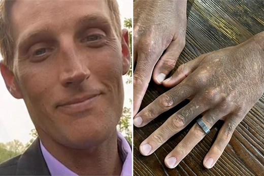 US man left with black skin after freak reaction to common anti-depressant