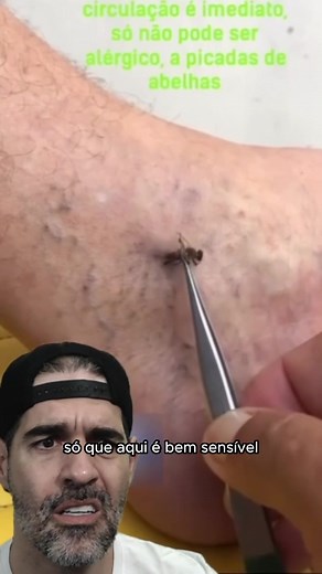 Apiterapia: Benefícios, Curiosidades e Tratamento com Abelhas