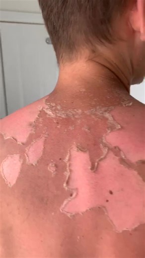 SOUND ON 🔊#sunburn #peeling #satisfying #fyp | sunburn peeling off